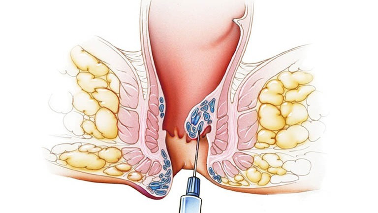 Những điều cần biết về tiêm xơ búi trĩ không cần phẫu thuật