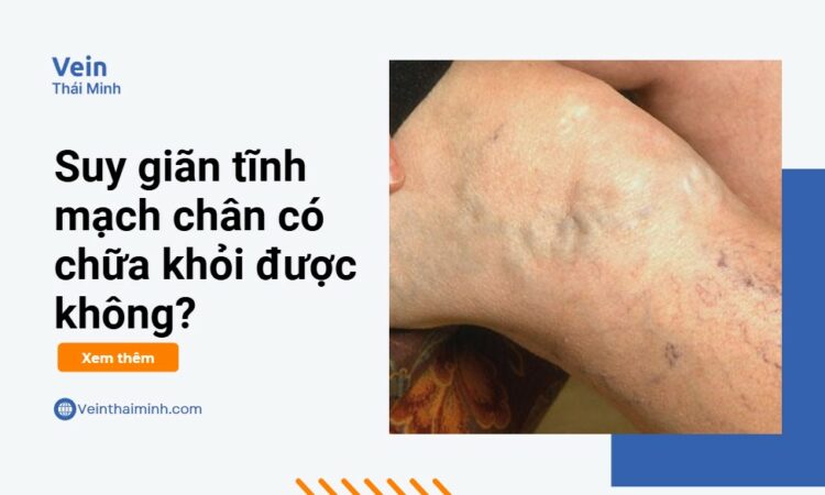 Suy giãn tĩnh mạch chân có chữa được không?