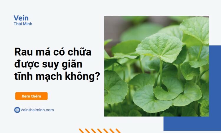 Rau má chữa suy giãn tĩnh mạch – Có nên áp dụng?