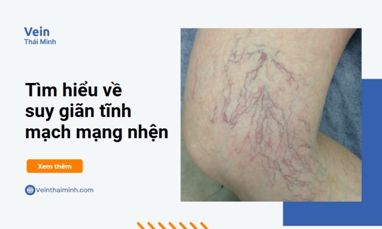 Giãn tĩnh mạch mạng nhện ở chân có nguy hiểm không?