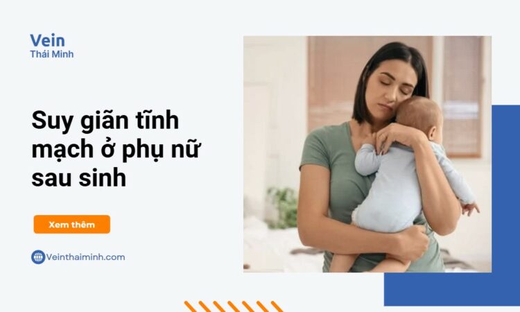 Suy giãn tĩnh mạch ở phụ nữ sau sinh – Đừng chủ quan!