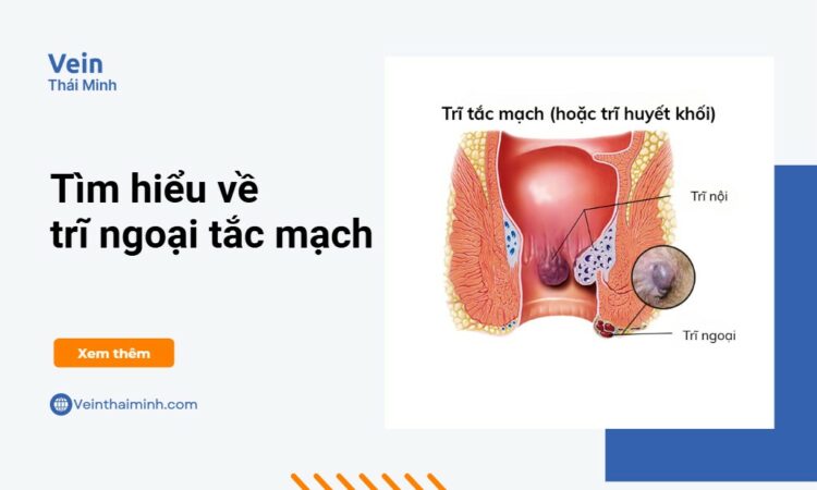 Trĩ ngoại tắc mạch – Triệu chứng và đối tượng dễ mắc phải