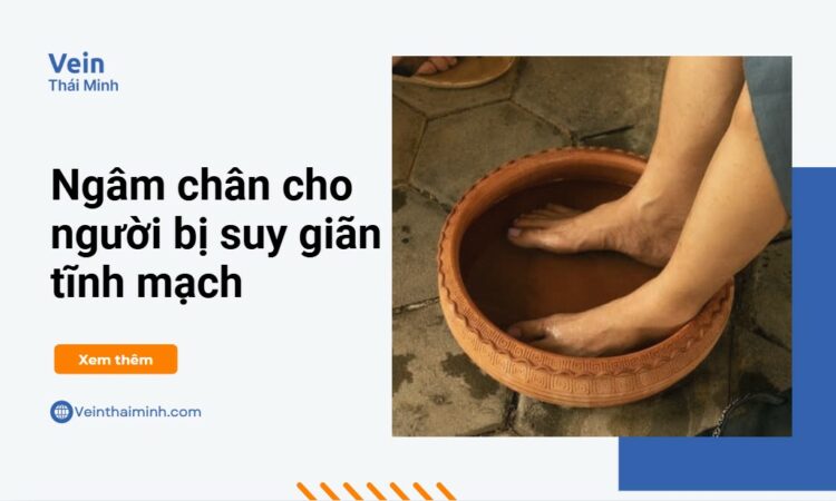 Ngâm chân trị suy giãn tĩnh mạch – các bước quan trọng