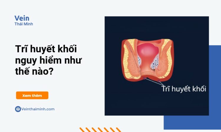 Trĩ huyết khối – Đối tượng mắc bệnh và phương pháp điều trị Trĩ huyết khối – Đối tượng mắc bệnh và phương pháp điều trị